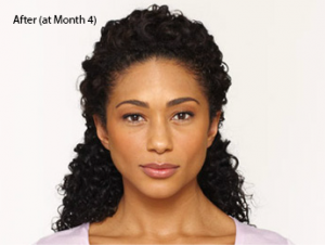 botox-before-and-after-african-american-whittier-month4