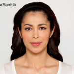 botox-before-and-after-latina-whittier-month3