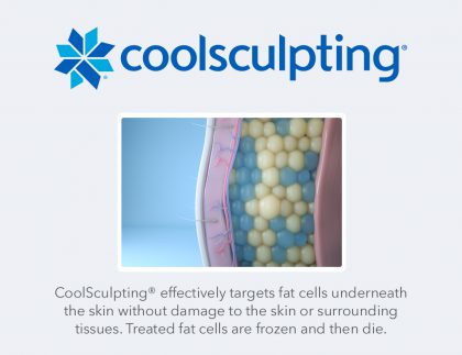 best-coolsculpting-in-torrance