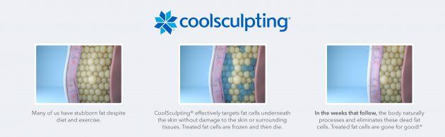 best-coolsculpting-in-torrance