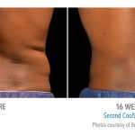 mens-coolsculpting-before-after-whittier-med-spa
