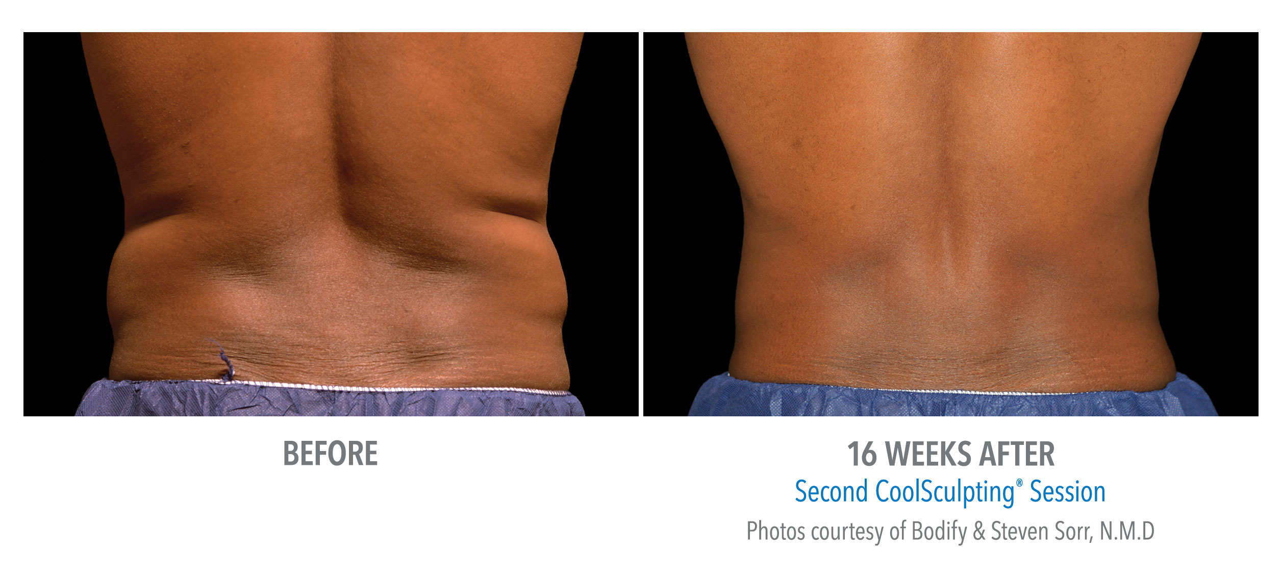 mens-coolsculpting-before-after-whittier-med-spa