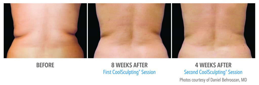 torrance-coolsculpting-back-flank-lower flank-coolsculpting