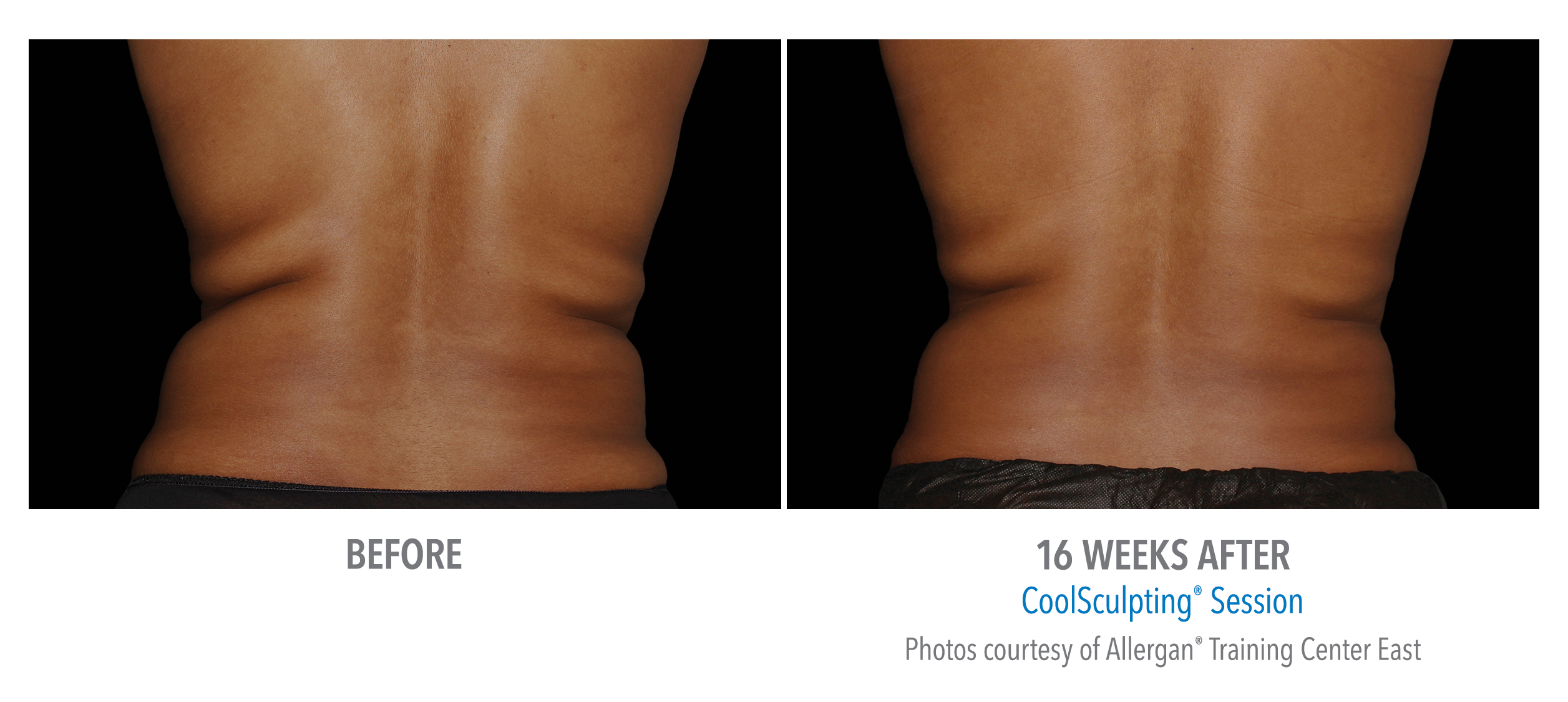 whittier-coolsculpting-back-flank-lower flank-coolsculpting5