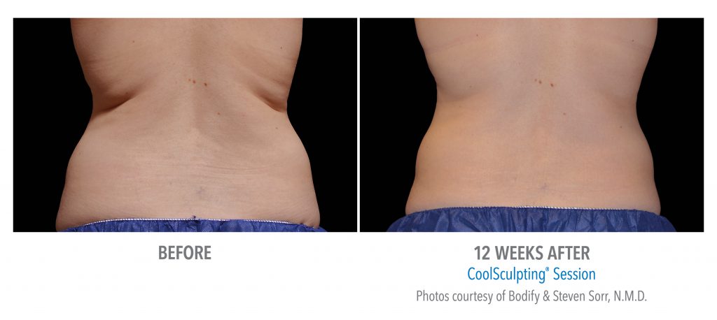 whittier-coolsculpting-back-flank-lower flank-coolsculpting6