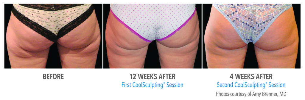 whittier-coolsculpting-thighs-banana-roll