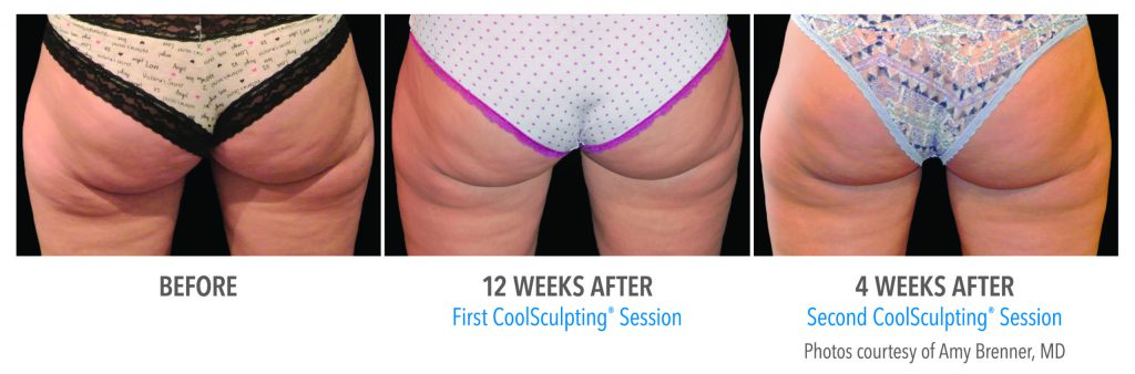 torrance-coolsculpting-thighs-banana-roll