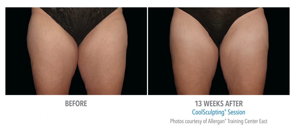 whittier-coolsculpting-thighs-inner-thigh-5