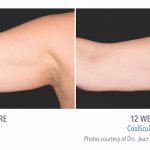 Coolsculpting arm Fat in whittier
