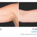 Coolsculpting Arm Fat near Torrance