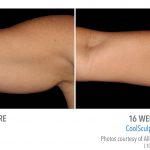 Coolsculpting arm Fat near Torrance