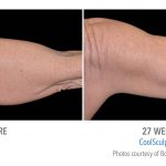 Coolsculpting arm weight loss in whittier