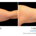 Coolsculpting arms whittier