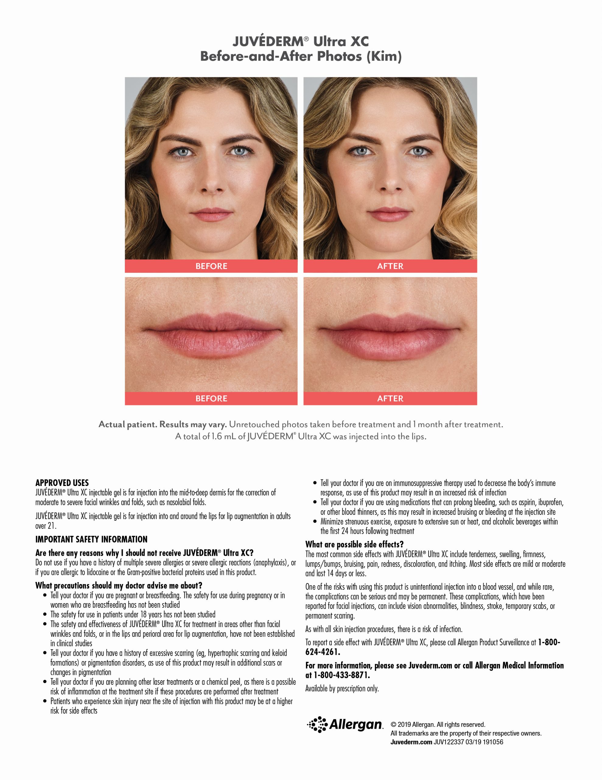 Juvederm Before & After-kim