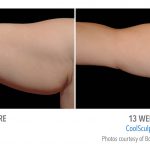 arm coolsculpting torrance