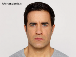 botox-before-after-caucasian-male-whittier-month3