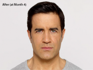 botox-before-after-caucasian-male-whittier-month4