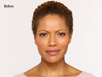 botox-before-and-after-african-american-south-bay-before