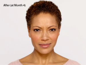 botox-before-and-after-african-american-south-bay-month4