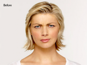 botox-before-and-after-caucasian-whittier-before