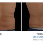 Coolsculpting mens back flank Torrance