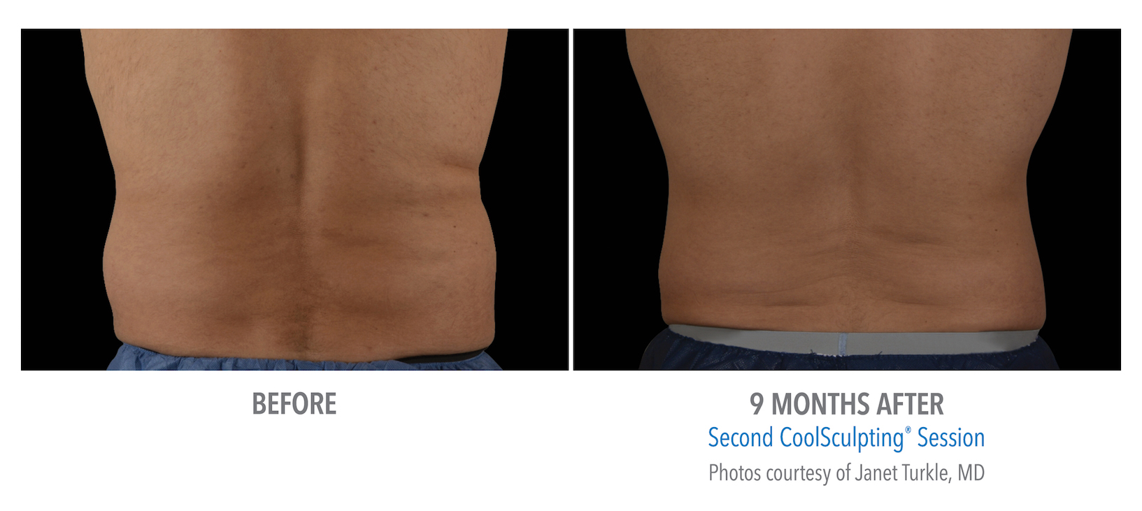 Men's Coolsculpting Before & Afters | Whittier Med Spa ...