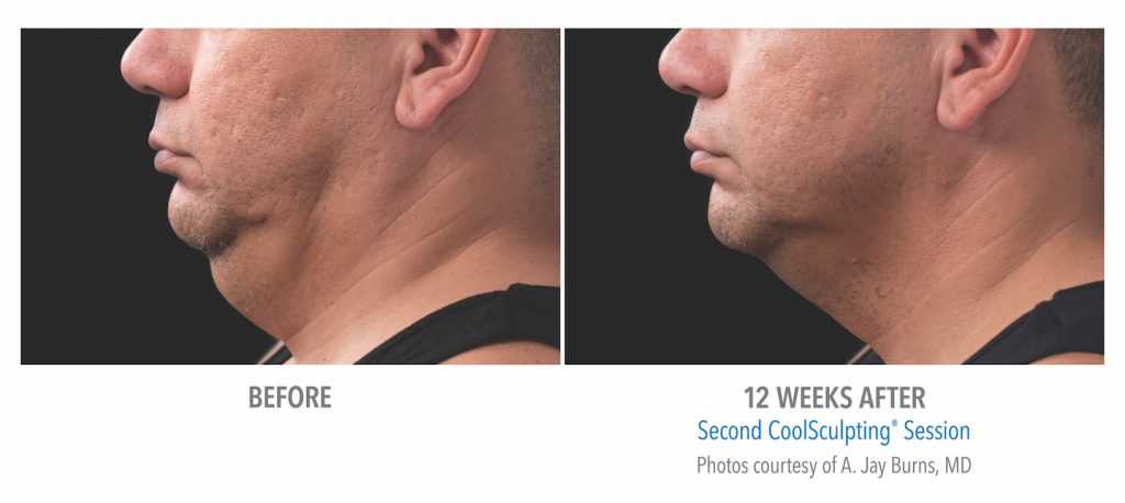 coolsculpting mens under chin near whittier