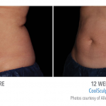 coolsculpting-stomach-abdomen-fat-loss-torrance