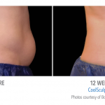 coolsculpting-stomach-fat-loss Torrance