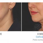 coolsculpting-under-chin-women-in-torrance-coolsculpting-before-and-after