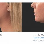 coolsculpting-under-chin-women-near-trorrance