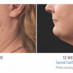 coolsculpting-under-chin-women-torrance-coolsculpting