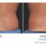 mens coolsculpting back flank in whittier