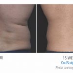 mens coolsculpting back flank near torrance