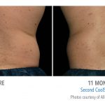 mens coolsculpting back flank torrance