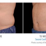 mens coolsculpting stomac whittier
