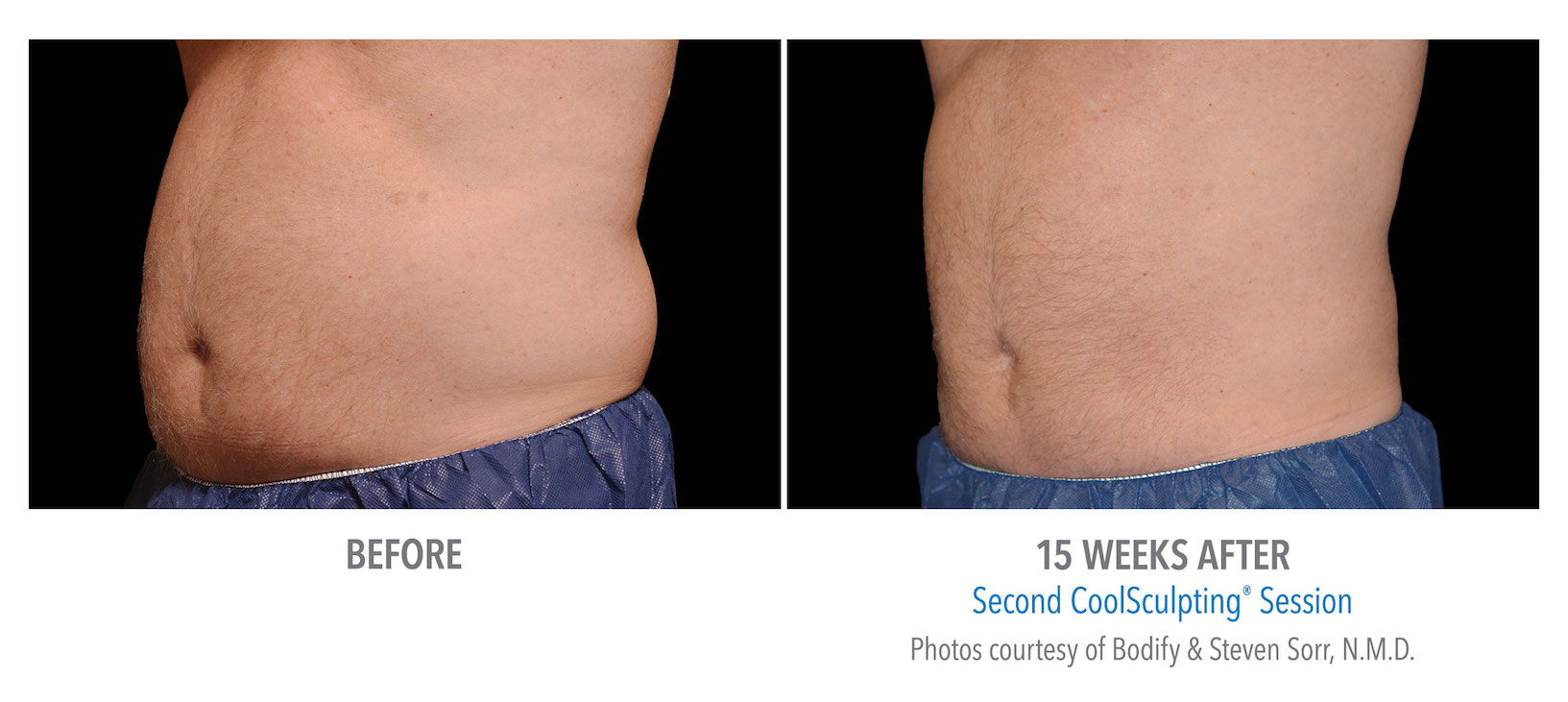 mens coolsculpting stomac whittier