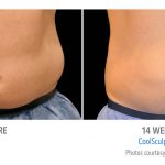 mens coolsculpting stomach flank whittier