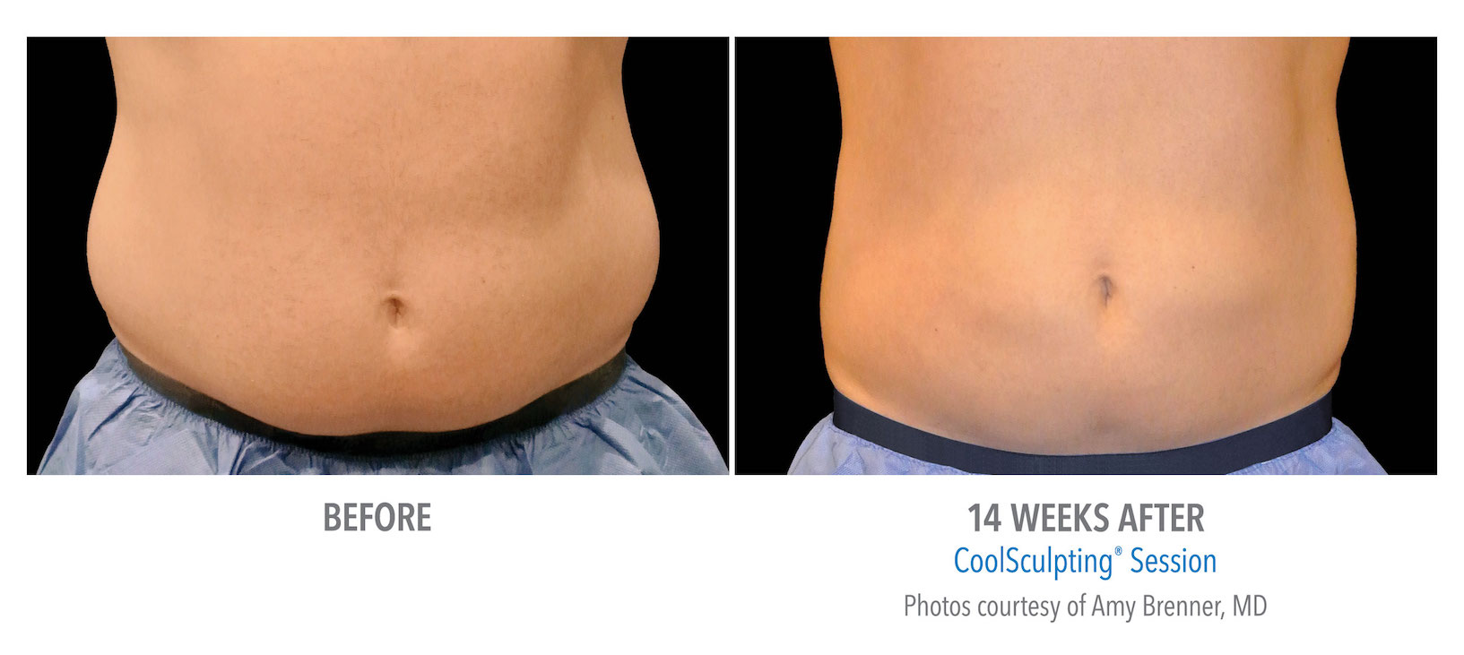 mens coolsculpting stomach flank whittier