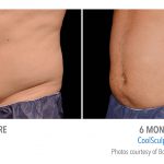 mens coolsculpting stomach in whittier
