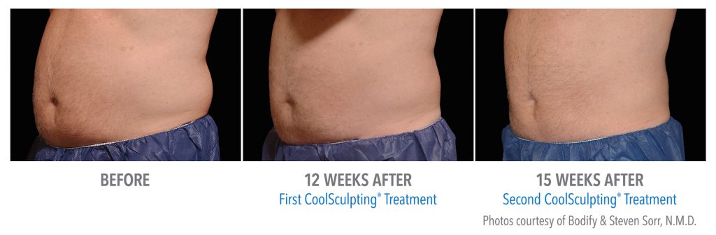 mens coolsculpting stomach near whittier