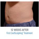 mens coolsculpting stomach near Torrance