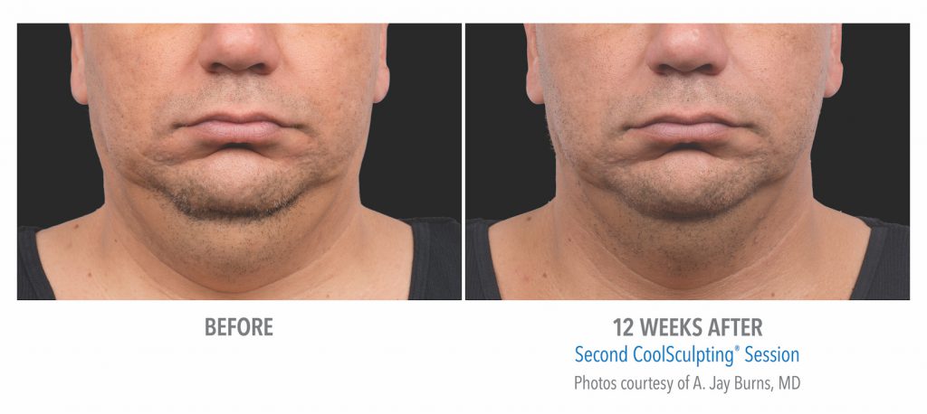 mens coolsculpting under chin near whittier