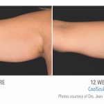 whittier Coolsculpting arm Fat