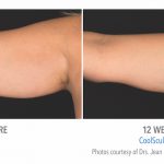 Torrance Coolsculpting Arm Fat