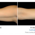 whittier Coolsculpting arm weight loss