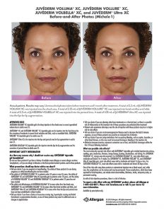 whittier-Juvederm-before-after-Michele