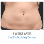 whittier-coolsculpting-stomach-fat-loss
