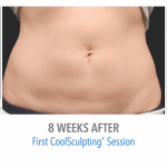 torrance-coolsculpting-stomach-fat-loss