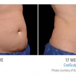 whittier-coolsculpting-stomach-weight-burn